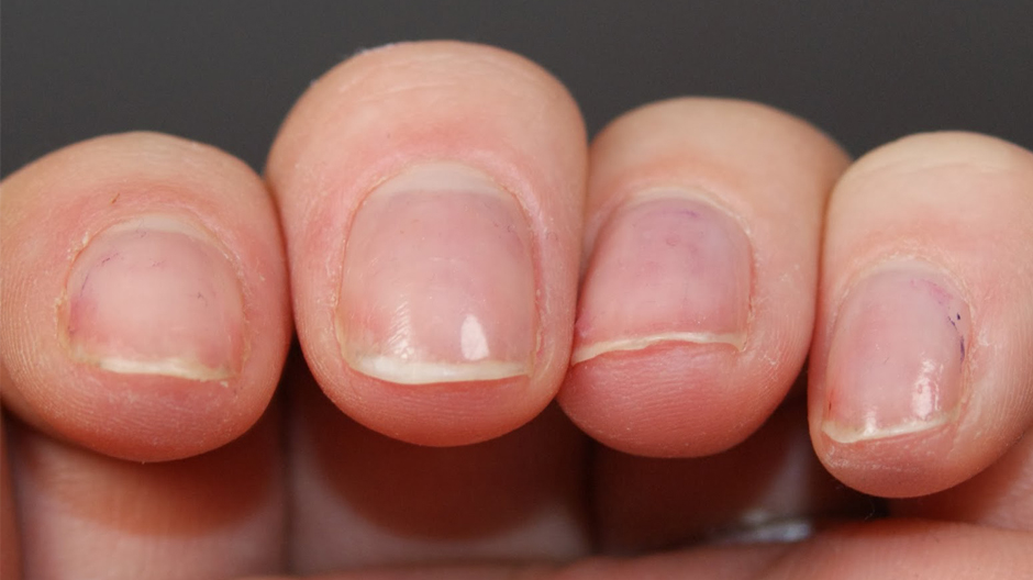 Ногти деформируются волнами при плохом питании