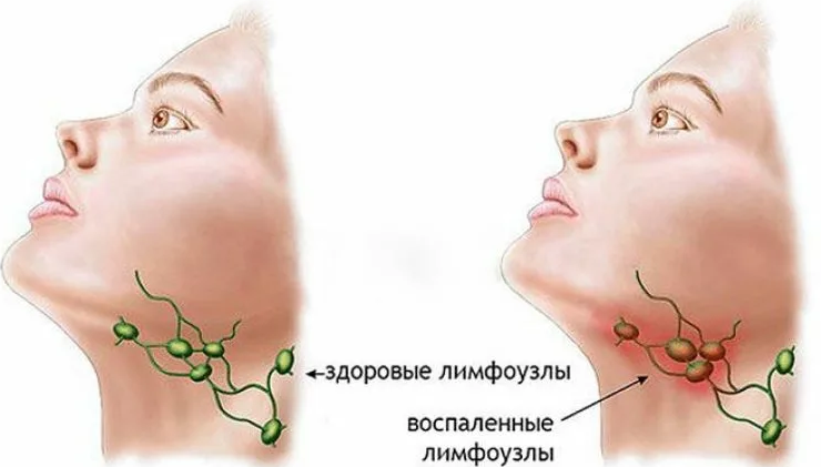 Субмандибуларен лимфаденит