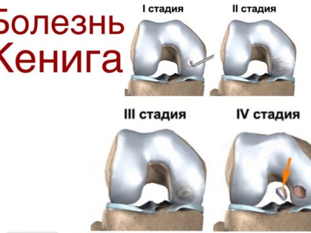 Болезнь Кенига коленного сустава: причины, стадии заболевания, проявления и симптомы, диагностика, лечение