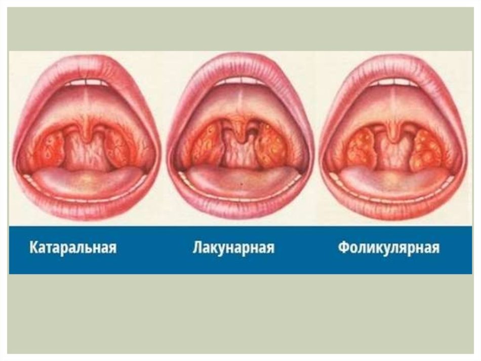 Types of tonsillitis