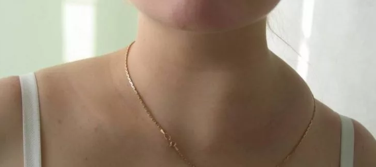 The bump on the neck on the left side got out