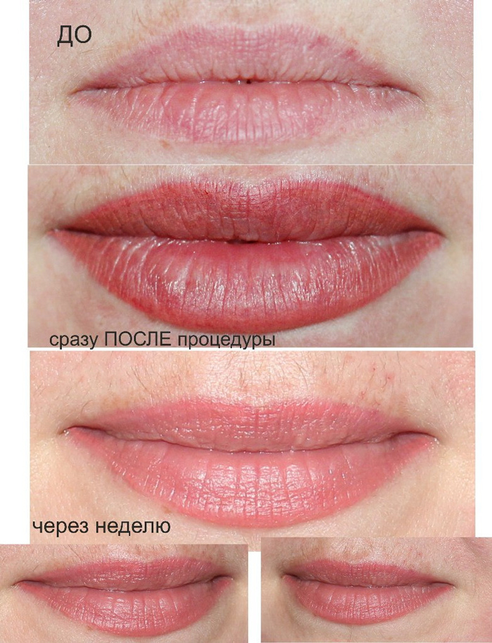 Tatouage des lèvres: avant la procédure, guérison, résultat final
