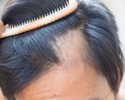 Que faire si vous êtes chauve - Alopécie: symptômes, causes, produits de traitement, masques de croissance des cheveux, prévention. Que faire avec une perte de cheveux sévère après le coronavirus?