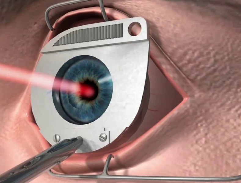 Presbiopia - Hur man behandlar: laserkorrigering
