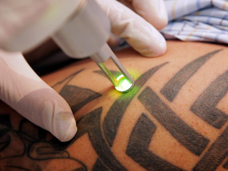 Removing a laser tattoo