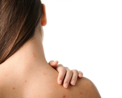 Acne on the back of girls and women: signs, which organ is responsible for