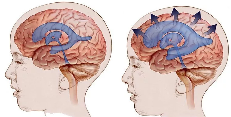 Pression intracrânienne chez un enfant