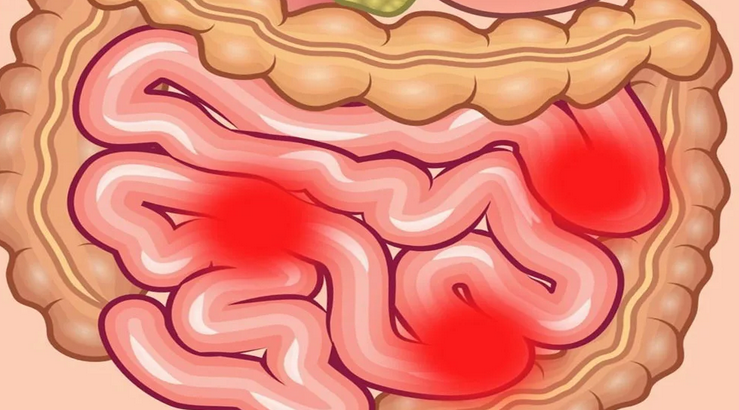 Gyomor -bélrendszeri betegségek: Enteritis