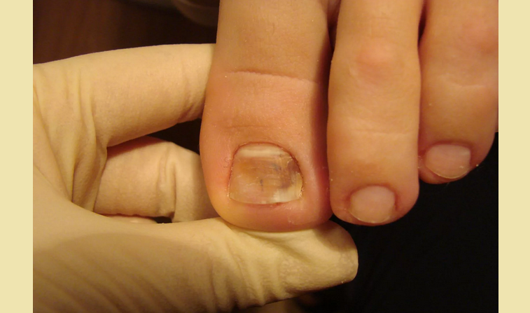 Болезнь ногтей на пальцах ног