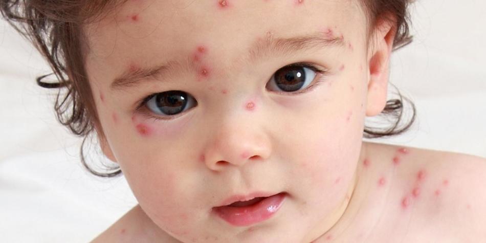 A rash in a child