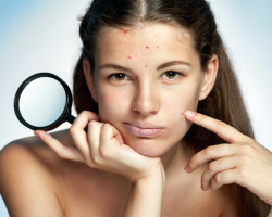 Problème Skin - Soins: masques, huiles, cosmétiques. Traitement de l'acné et de l'acné avec une peau problématique