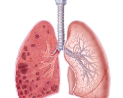Emfisema paru -paru: Apa itu, penyebab, gejala, prognosis penyakit, pencegahan