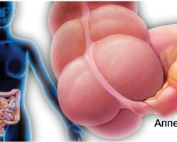 Hol van az appendicitis, melyik oldalról fáj? A felnőtt nőkben, a férfiakban, a serdülőkben, a terhesség alatt a appendicitis jelei, tünetei és okai a terhesség alatt