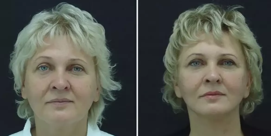 Птоз лица фото после 40 лет