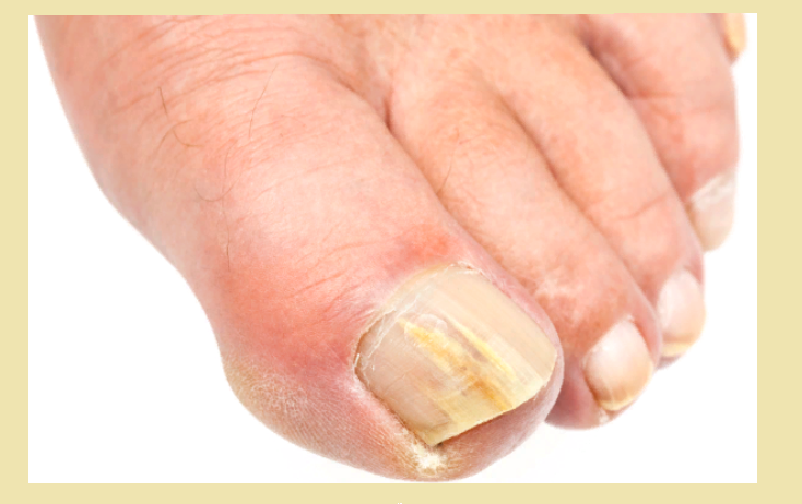Заболевание ногтей на пальцах ног