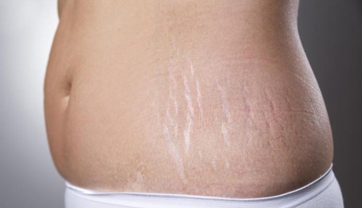 Nackdel i utseendet på en kvinna nr 4, som skrämmer bort män: stretchmärken på höfterna, magen och bröstet