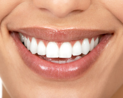 Apa itu veneer? Winirs on the Teeth: Pro and Cons, foto sebelum dan sesudah