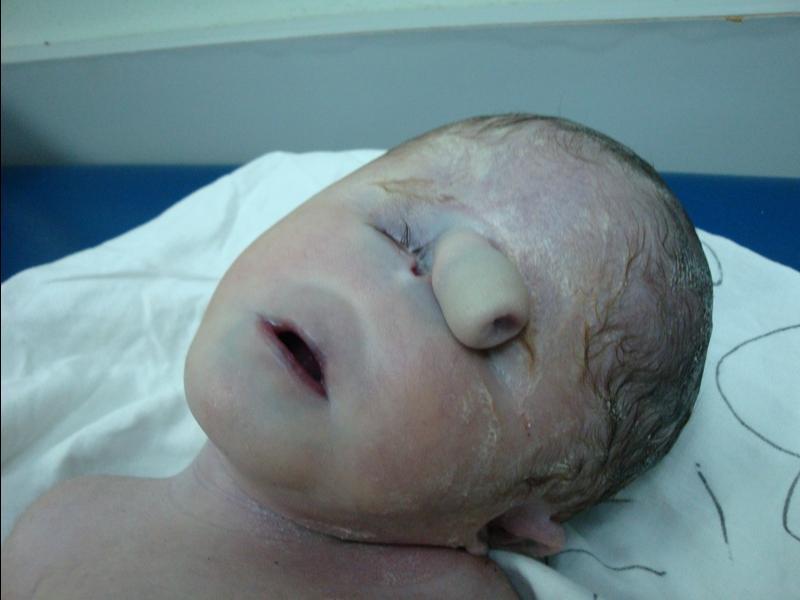 Syndrome de Patau chez les enfants: Photos de nouveau-nés