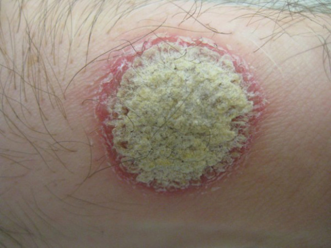 Sodium thiosulfate for cleansing the body during psoriasis