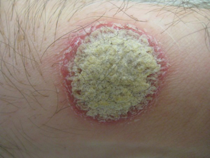 Natriumthiosulfat zur Reinigung des Körpers während der Psoriasis