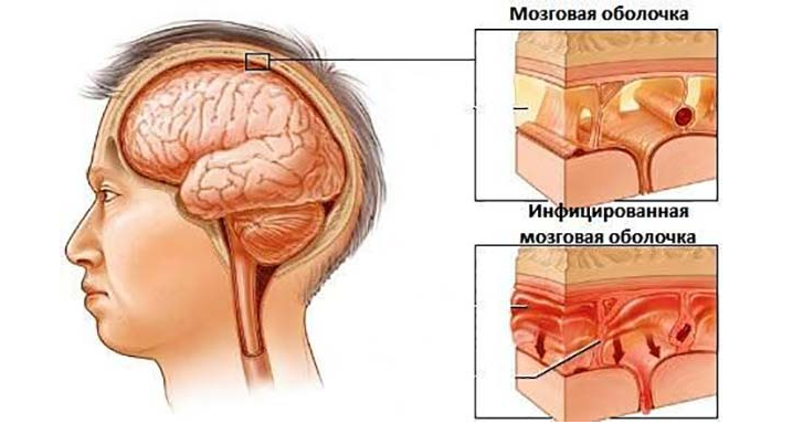 Meningitis fertőző vírus