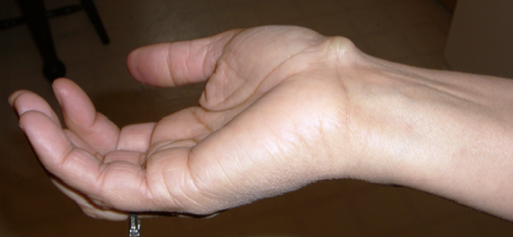 Большая шишка на сгибе кисти (запястье) руки