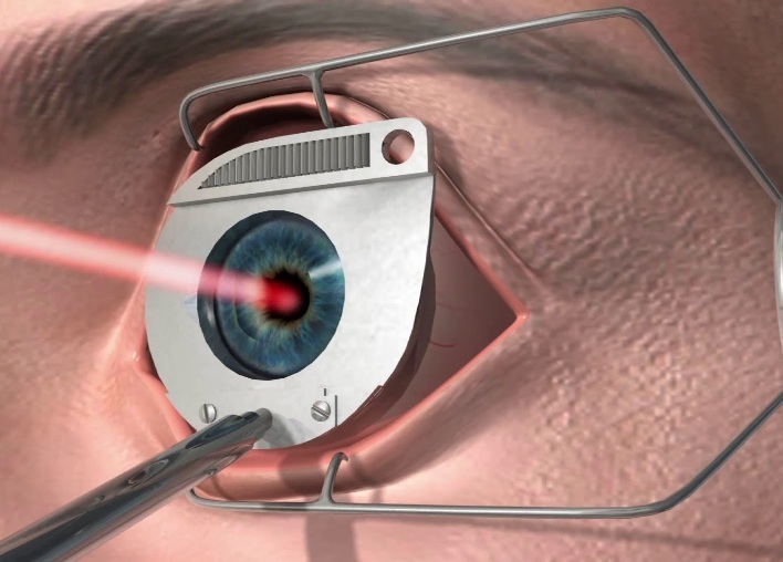 Effectuer une opération de glaucome ou de cataractes ou non, le médecin décide