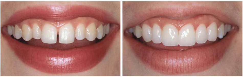 Veneers before and after