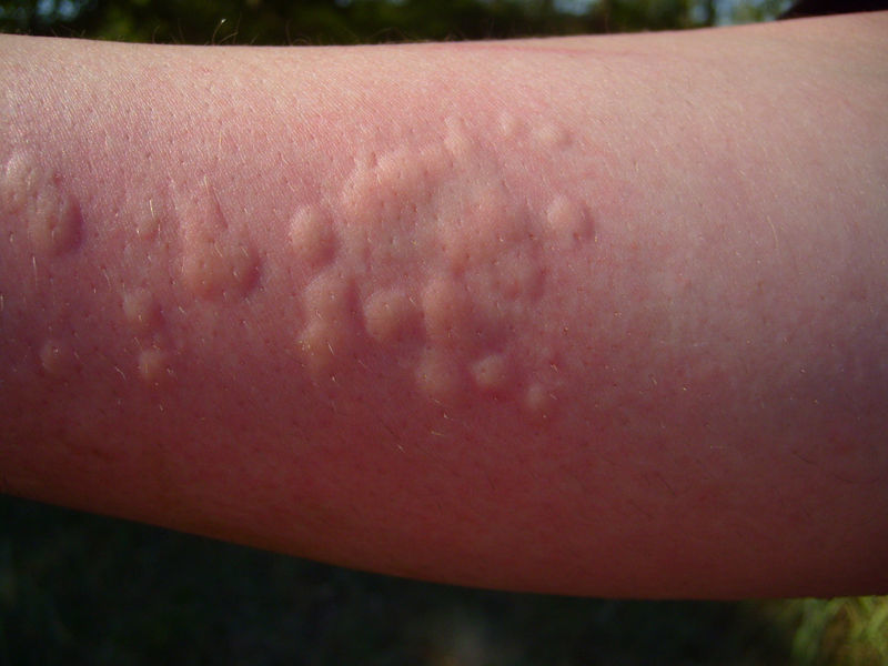 Réaction cutanée d'un allergène