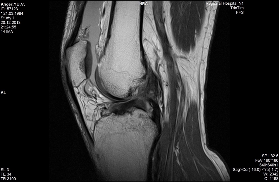Bunch of ligaments on MRI