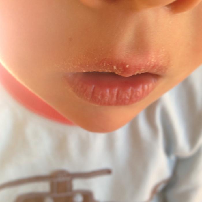 Трескаются губы у ребенка