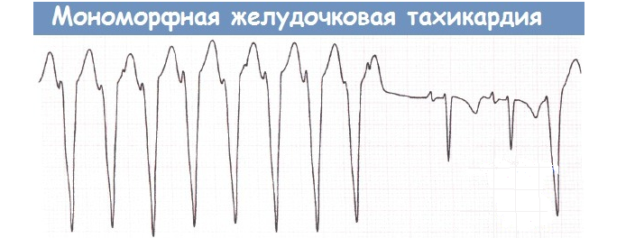 Monomorfna želodčna tahikardija na EKG