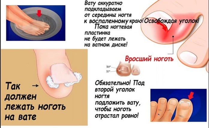 First aid with an ingrown nail at home