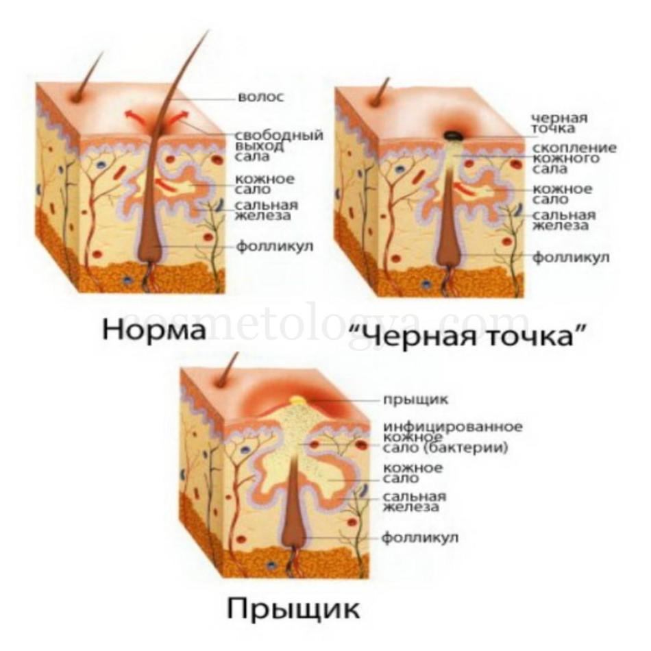 Clogged sebaceous gland