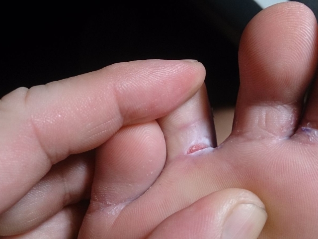 Deep, non -healing cracks and peeling of the skin on the fingers and between the toes, near the nail, on the pads, phalanxes: causes and treatment, the best ointments, folk remedies. What to do with cracks on the toes in adults and children?