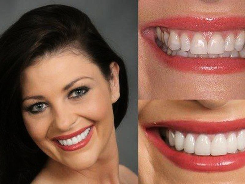 Profesionalno beljenje zob. 0003AC15_361570