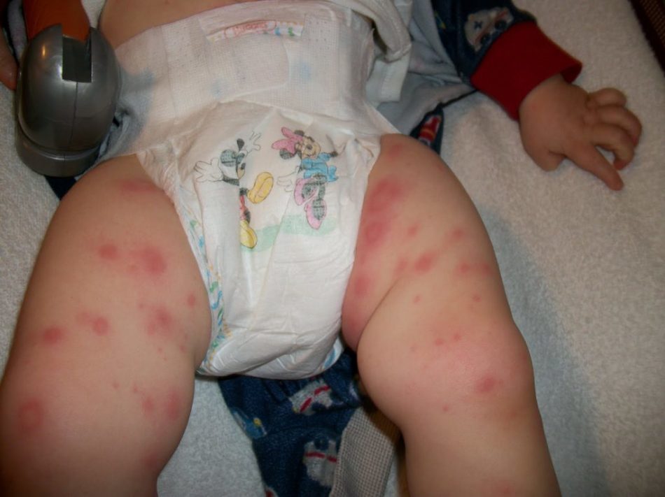 Αλλεργία αντιβιοτικών σε ένα παιδί