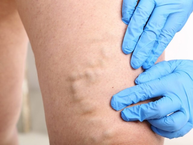 Home remedies for varicose veins. Which ones are effective?