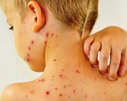 Streptoderma kod djece: znakovi, vrste, razdoblje inkubacije, liječenje, prevencija