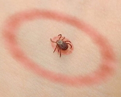 Lyme disease: what is it, who is the causative agent, symptoms, forecast