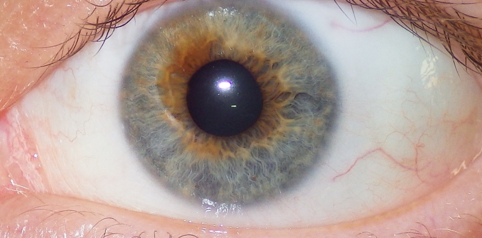 Acquired heterochromia can be a symptom of a serious eye disease