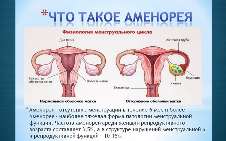 Amenorrhoea a nőkben