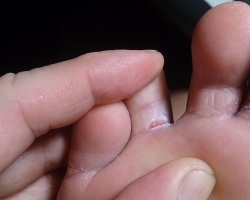 Deep, non -healing cracks and peeling of the skin on the fingers and between the toes, near the nail, on the pads, phalanxes: causes and treatment, the best ointments, folk remedies. What to do with fingers on the fingers in adults and children?