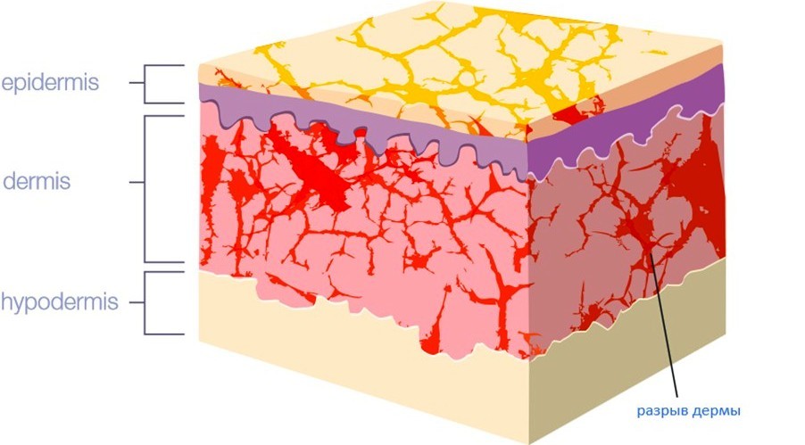 Stracks Formation Scheme