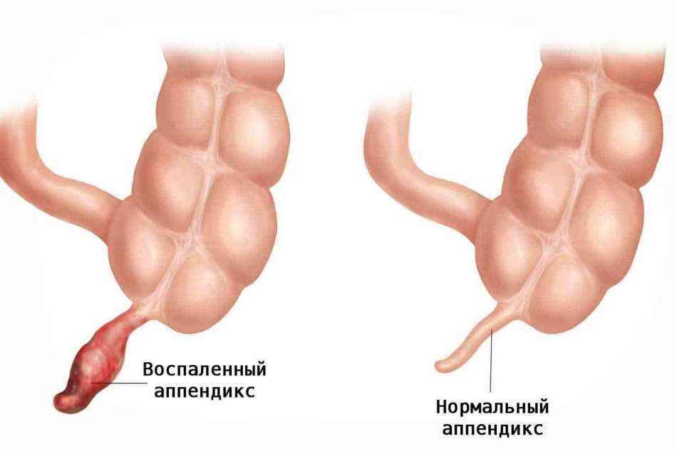 Острый флегмонозный аппендицит