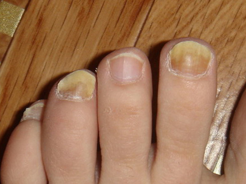 Pictures on request yellow nails