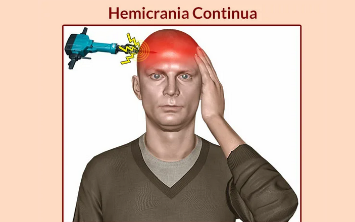 Paroxysmal hemicrania