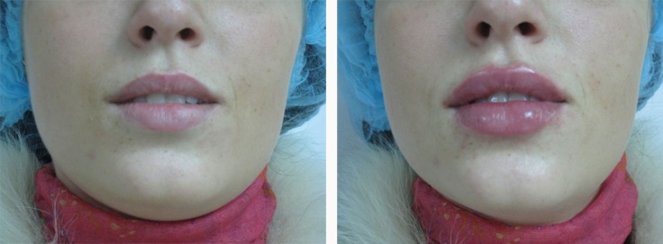 Увеличение губ гиалуроновой кислотой: фото "до" и "осле"