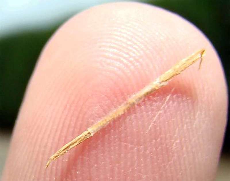 A splinter in the finger