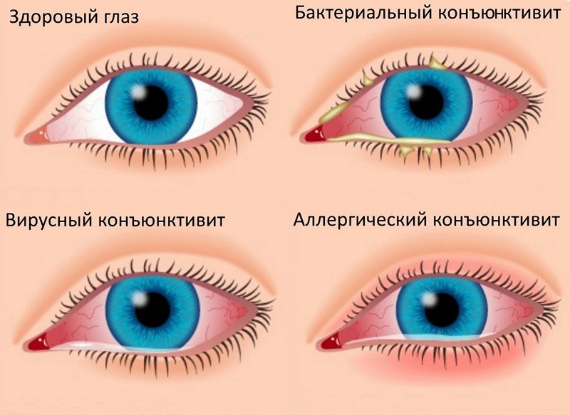 What ointment treats conjunctivitis?